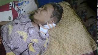 Perembuan Buta dan Lumpuh Penderita Diabetes Luka Dileher Warga Bojane